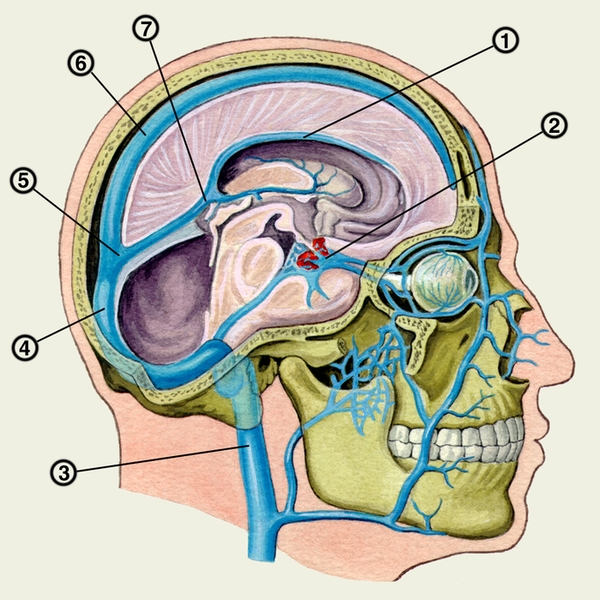 Рис. 2. Венозные синусы твердой мозговой оболочки: 1 — нижний сагиттальный синус; 2 — межпещеристый синус; 3 — внутренняя яремная вена; 4 — поперечный синус; 5 — <a href=