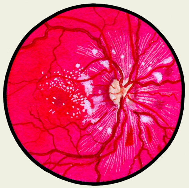 Рис. 8. Глазное дно в норме и при патологии. Гипертоническая ретинопатия: артерии сетчатки резко сужены, вены расширены, извитые, по ходу сосудов очаговые кровоизлияния и плазморрагии; сетчатка вокруг диска зрительного нерва отечна