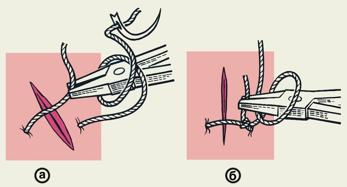 Рис. 3. Схематическое изображение инструментального (аподактильного) способа завязывания хирургического узла: а — после выкола иглы длинным концом нити обернут <a href=