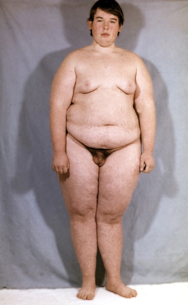 Рис. а). Мальчик с адипозогенитальной дистрофией (вид спереди): видны общее ожирение, гинекомастия, слабая выраженность вторичных половых признаков, недоразвитие яичек и мошонки