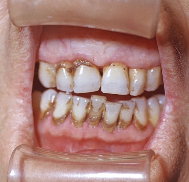 Зубной камень в виде темных плотных отложений у шеек зубов