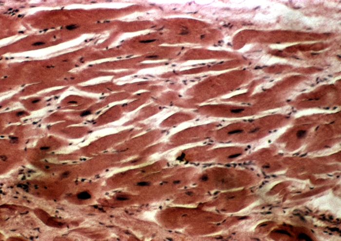 Рис. б). Микропрепараты сердечной мышцы: при гипертрофии миокарда (видны резко утолщенные мышечные волокна с крупными гиперхромными ядрами). <a href=