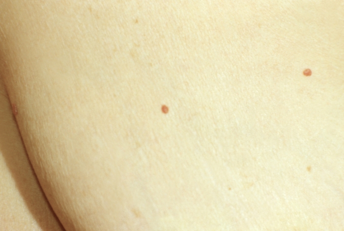 Рис. 5. Микроаневризмы в виде ярко-красных пятнышек на коже туловища при хроническом панкреатите