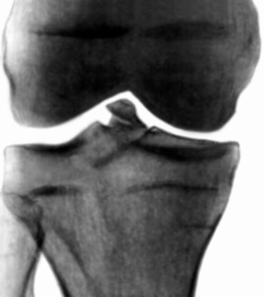Рис. 24. Рентгенограмма коленного сустава при переломе межмыщелкового возвышения большеберцовой кости