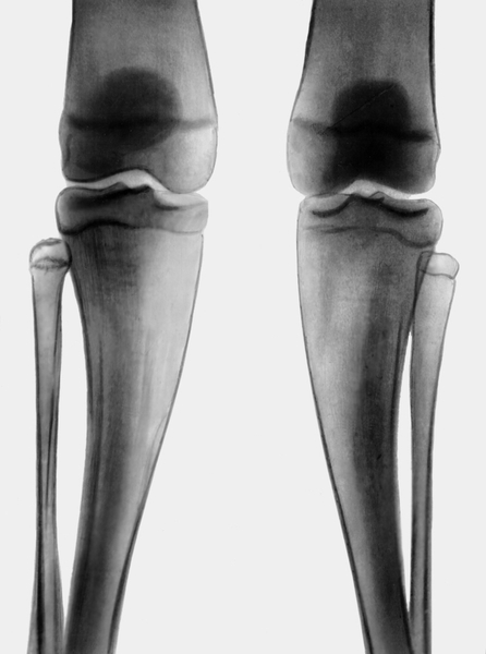 Рис. 42. Рентгенограмма коленных суставов при болезни Пайля: расширение метадиафизов и вальгусное отклонение костей голеней