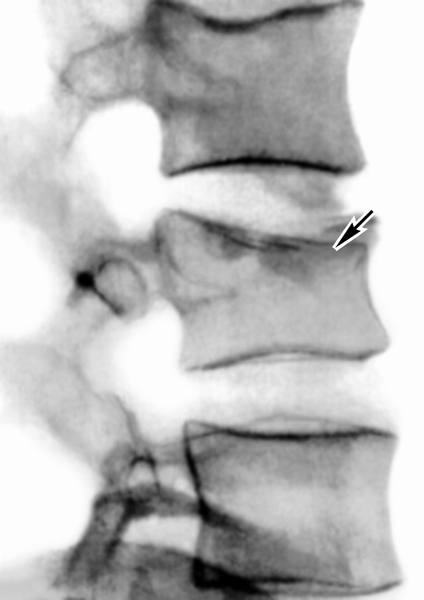 Рис. 10а). Рентгенограмма поясничного отдела позвоночника (боковая проекция) при компрессионном переломе со средней степенью компрессии: стрелкой указано тело поврежденного позвонка