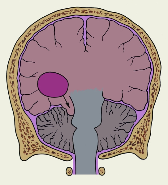Рис. 2. Схематическое изображение фронтального разреза головы при синдроме тенториального вклинения, обусловленном опухолью височной доли: стрелка, идущая от опухоли, показывает направление вклинения вещества полушарий большого мозга