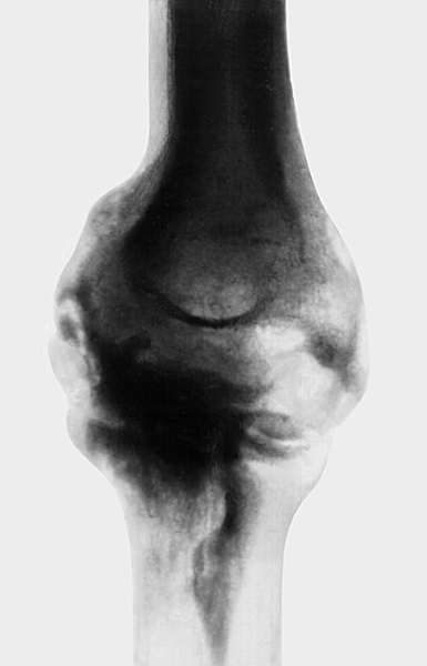 Рис. 13а). Рентгенограмма локтевого сустава при параартикулярной оссификации — переднезадняя проекция