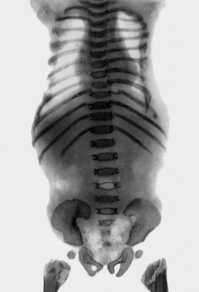 Рис. 7. Рентгенограмма грудной клетки при метатропической дисплазии у ребенка 1 года: сужение грудной клетки, наиболее выраженное в верхней ее части