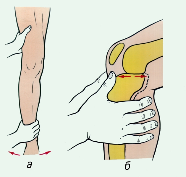 Рис. 1. Способ определения повреждения боковых связок коленного сустава (а) и выявление симптома «выдвижного ящика» при повреждении крестообразных связок коленного сустава (б)