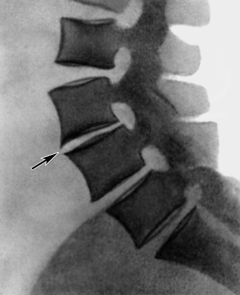 Рис. 8. Рентгенограмма поясничного отдела позвоночника при поясничном остеохондрозе (боковая проекция): сужение (указано стрелкой) межпозвоночного диска между III и IV поясничными позвонками, замыкающие пластинки тел позвонков склерозированы