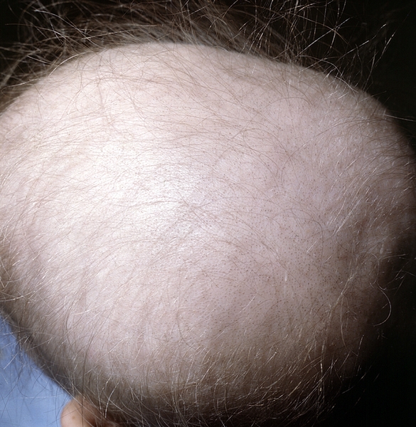 Рис. 1. Резкое поредение волос на голове при врожденной алопеции