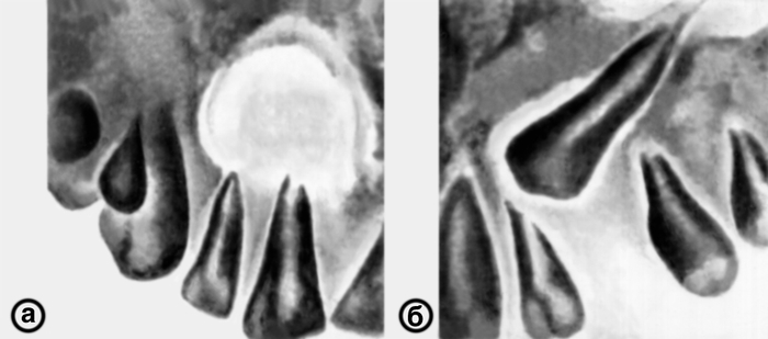Внутриротовые рентгенограммы зубов верхней челюсти при радикулярной (а) и фолликулярной (б) зубной кисте