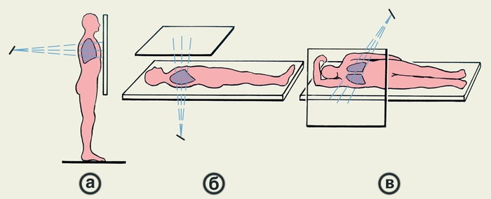 Рис. 1. Положение больного по отношению к плоскости флюороскопического экрана и направлению пучка рентгеновского излучения при ортоскопии (а), трохоскопии (б), латероскопии (в)