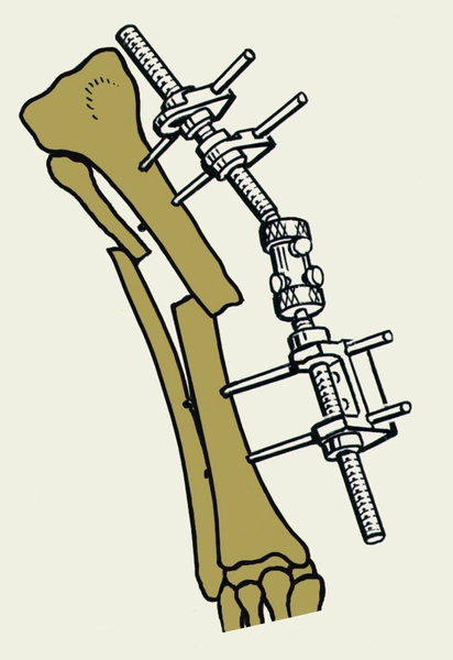 Рис. 2а). Стержневой дистракционно-компрессионный аппарат СКИД на костях голени до репозиции отломков берцовых костей