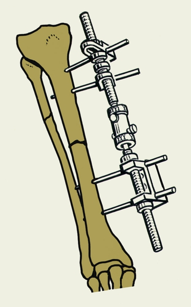Рис. 2б). Стержневой дистракционно-компрессионный аппарат СКИД на костях голени после репозиции отломков берцовых костей