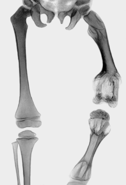 Рис. 37. Рентгенограмма бедренных и большеберцовых костей при дисхондроплазии: зоны просветления в области метафизов левой бедренной и левой большеберцовой костей, укорочение левой нижней конечности за счет уменьшения длины этих костей