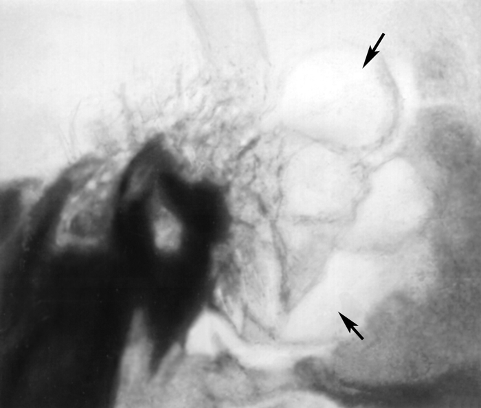Рис. б). Рентгенограмма левой височной кости (боковая проекция) при гнойном мастоидите — на месте ячеистой структуры сосцевидного отростка виден <a href=