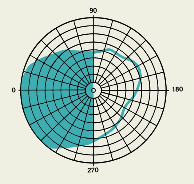 Рис. 3а). Схема изменений полей зрения при битемпоральной гемианопсии (при поражении волокон зрительного перекреста); голубым цветом обозначены выпавшие поля зрения