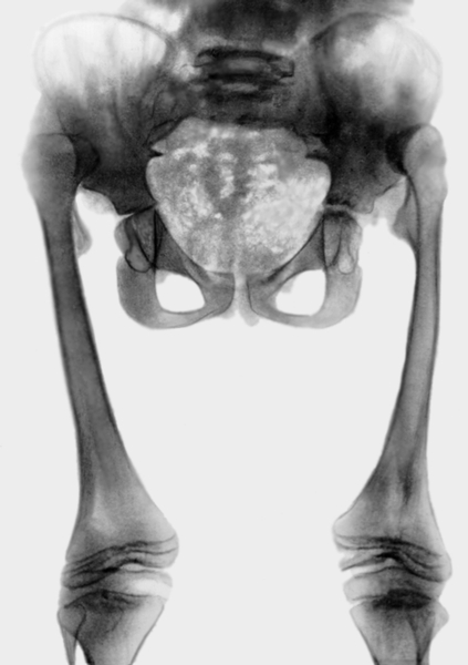 Рис. 4а). Рентгенограмма таза, бедер и коленных суставов при диастрофической дисплазии: вывихи в коленных и тазобедренных суставах