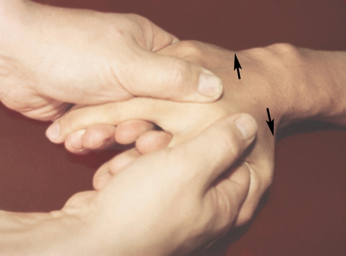 Рис. 3ж). Основные приемы массажа. Приемы разминания — сдвигание II и III пястных костей (вспомогательный прием разминания); используется для воздействия на межкостные мышцы; массажист захватывает двумя руками (I и II пальцами) пястные <a href=
