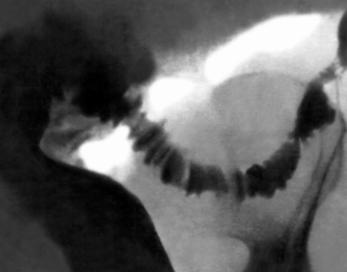 Рис. 2. Рентгенограмма участка толстой кишки при хроническом колите: кишка спазмирована, контуры ее имеют зубчатую форму