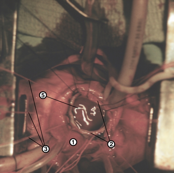 Рис. 33а). Операция по поводу сплошного дефекта межпредсердной перегородки, выполняемые на работающем сердце (видны магистрали аппарата искусственного кровообращения). Доступ к перегородке через правое предсердие (1), края дефектов (2) прошиты атравматическими П-образными швами (3), в центре решетчатого дефекта видна разделяющая его мембрана (4); блики (5) в просвете дефектов соответствуют поверхности крови в полости левого предсердия, уровень которой во время операции во избежание воздушной эмболии поддерживают не ниже межпредсердной перегородки