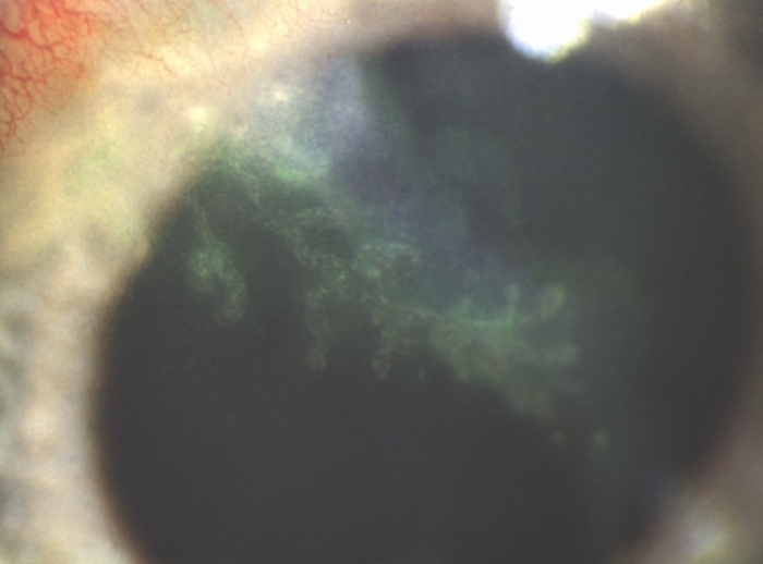 Рис. 2. Биомикроскопическая картина глаза при древовидном кератите: определяется древовидный инфильтрат (окрашен 1% раствором флюоресцеина)