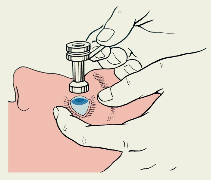 Рис. 2. Проведение аппланационной тонометрии с помощью тонометра Маклакова.