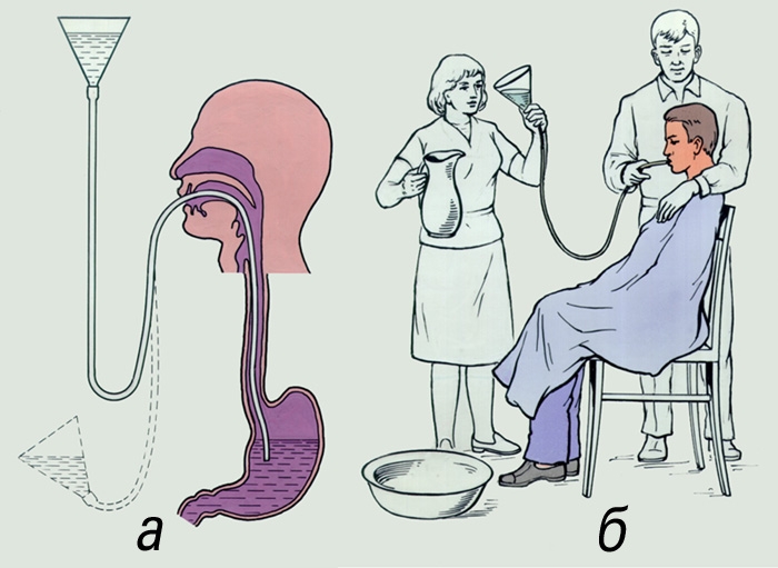 Промывание желудка с помощью зонда: а — схема промывания; б — техника промывания