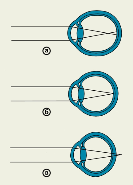 Схематическое изображения хода лучей в оптической системе глаза при различных видах клинической рефракции: а — при близорукости (задний главный фокус располагается перед сетчаткой); б — при эмметропии (задний главный фокус находится на сетчатке); в — при дальнозоркости (задний главный фокус располагается за сетчаткой)