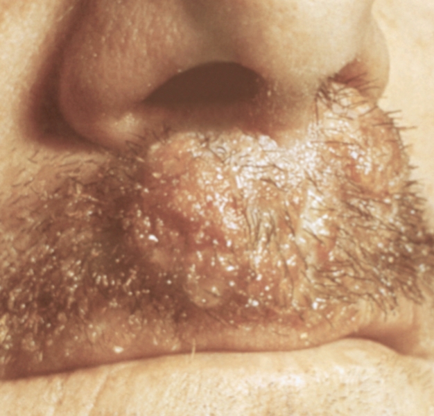 Рис. 4б. Инфильтративно-нагноительные очаги в области усов при паразитарном сикозе