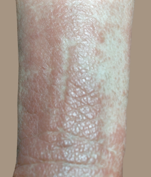 Рис. 2. Папулезные высыпания с сеткой Уикхема — сетевидным белесоватым рисунком на коже предплечья при красном плоском лишае