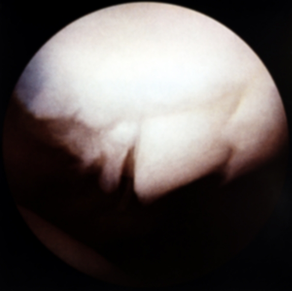 Рис. 15. Артроскопическая картина при трансхондральном переломе суставной поверхности надколенника: видны трещины и отломки хряща