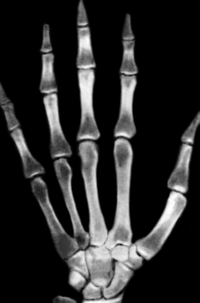 Рис. 1б). Рентгеновское изображение кисти в норме: негативное изображение, получаемое на рентгенограмме (более плотным тканям соответствуют более светлые участки изображения)