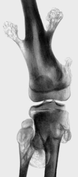 Рис. 34. Рентгенограмма коленного сустава при множественных костно-хрящевых экзостозах: костно-хрящевые <a href=