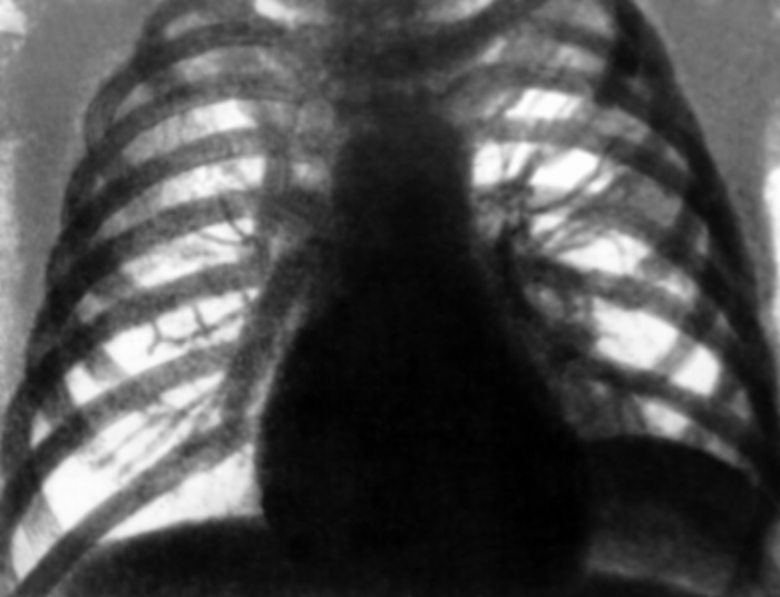 Рис. 3а). Рентгенограмма грудной клетки при левостороннем экссудативном плеврите, выполненная в ортопозиции: <a href=