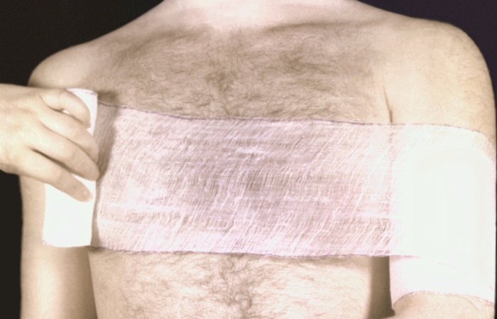 Рис. 11б). Наложение колосовидной повязки на плечо: фиксация плеча к груди