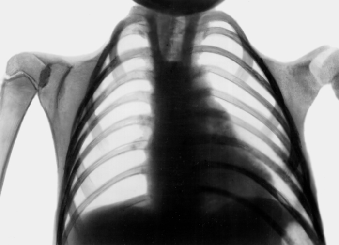 Рис. 18. Рентгенограмма грудной клетки при черепно-ключичной дисплазии: полное отсутствие ключиц