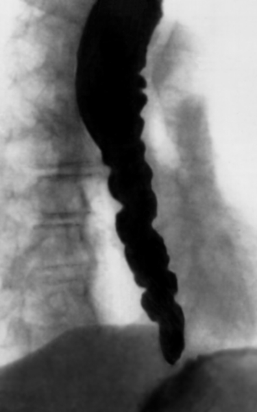 Рис. з). Рентгенологическая картина при различных заболеваниях и поражениях пищевода, сопровождающихся дисфагией: сегментарный спазм пищевода