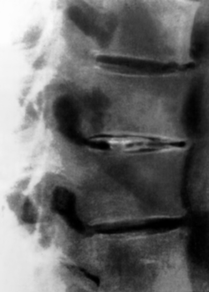 Рис. 7а). Рентгенограмма позвоночника (боковая проекция) при кальцификации межпозвоночных дисков: <a href=