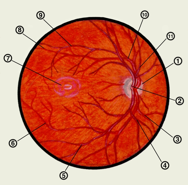 Рис. 1. Глазное дно в норме и при патологии. Глазное дно правого глаза в норме: 1 — диск зрительного нерва; 2 — воронка зрительного нерва с центральными сосудами сетчатки; 3 — нижняя носовая <a href=