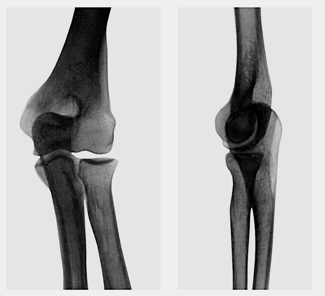 Рис. 5а). Рентгенограммы в прямой и боковой проекциях локтевого сустава