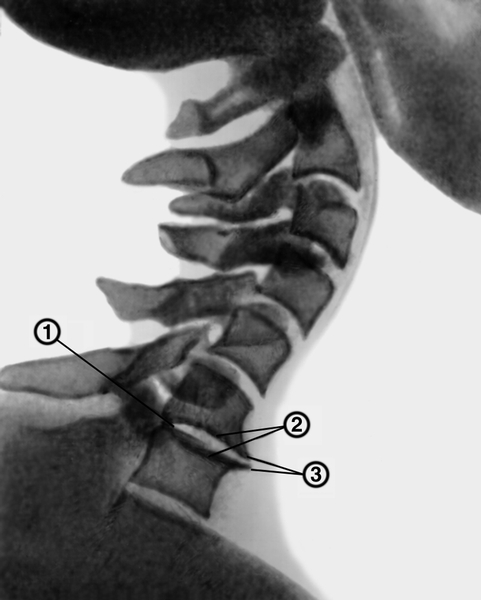 Рис. 6. Рентгенограмма шейного отдела позвоночника при шейном остеохондрозе (боковая проекция): 1 — небольшое сужение межпозвоночного диска между VI —VII позвонками; 2 — <a href=