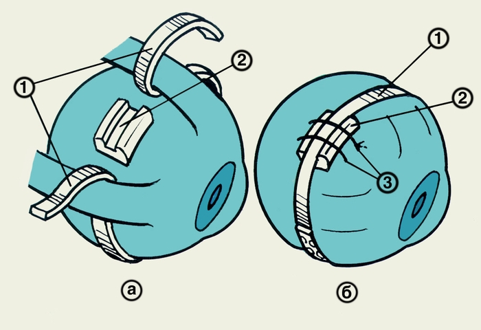 Рис. 2. Схематическое изображение глазного яблока при некоторых этапах циркляжа: а — наложение циркляжной ленты (1) и пломбы (2); б — циркляжная лента (1) затянута <a href=
