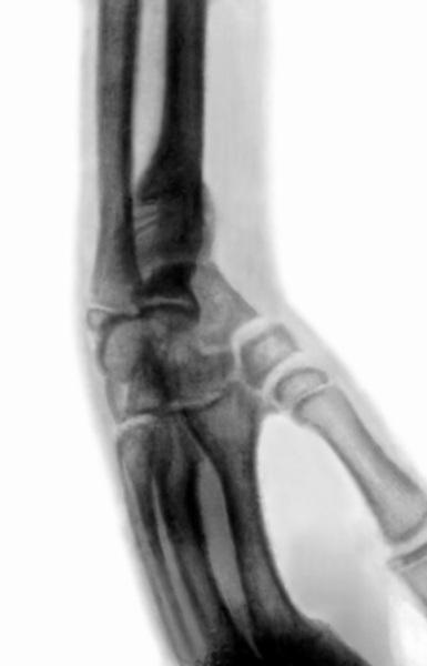 Рис. 3б). Рентгенограмма правого предплечья и кисти больного с приобретенной косорукостью в результате неправильного сращения перелома лучевой кости в типичном месте: боковая проекция