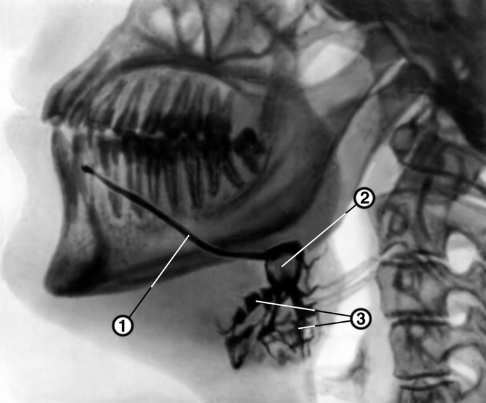 Рентгенограмма левой поднижнечелюстной железы при сиалолитиазе: 1 — <a href=