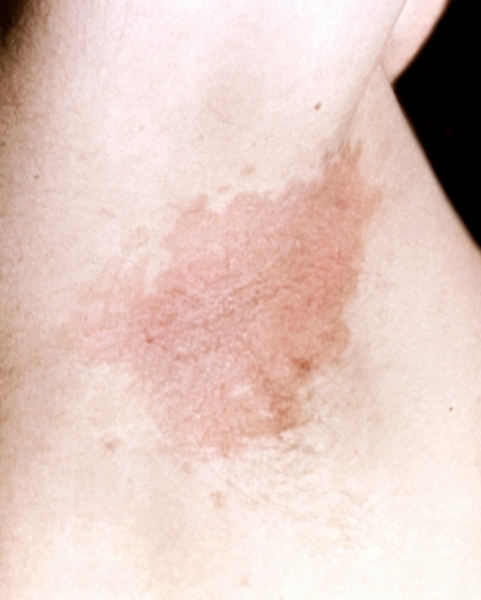 Эритразма в виде коричневатого пятна с неровными очертаниями в подмышечной впадине
