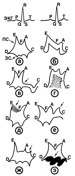 Рис. 12. Схема изображения на М-эхокардиограмме движения створок митрального клапана в норме (а) и при различных формах патологии (б—з): а — в норме во вемя диастолы отмечается расхождение створок митрального клапана, изображение передней створки (ПС) имеет М-образную, а задней (ЗС) — W-образную форму; фазы движения передней створки характеризуют точки О — начало открытия створок в диастолу; Е — максимальная амплитуда открытия передней створки: Р — прикрытие створки в фазе редуцированного наполнения; А — вершина колебания (открытия) створки во время систолы предсердий: С — закрытие створок клапана в начале систолы желудочков; б — митральный стеноз, амплитуда открытия передней створки в точках Е, А снижена, уменьшена скорость диастолического прикрытия (спада отрезка EF), обе створки движутся в одном направлении, в — пролапс передней створки; на систолическом отрезке АС появляется дополнительное движение в виде прогиба (указан стрелкой), г — <a href=