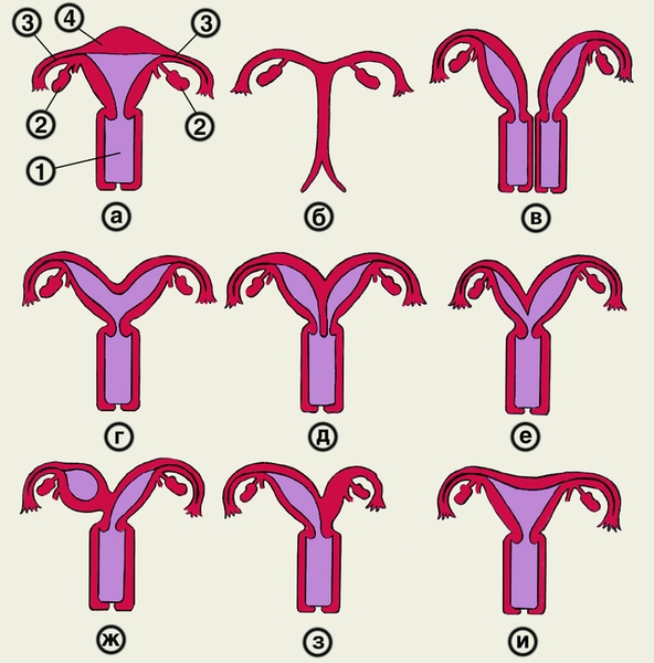 Рис. 4. Схематическое изображение внутренних половых органов женщины в норме и при некоторых пороках развития матки и влагалища: а — <a href=